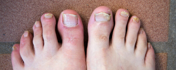 Recurring Fungal Nail Infections