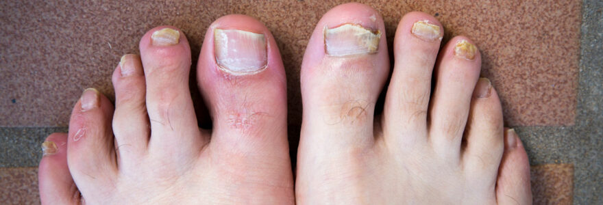 Recurring Fungal Nail Infections